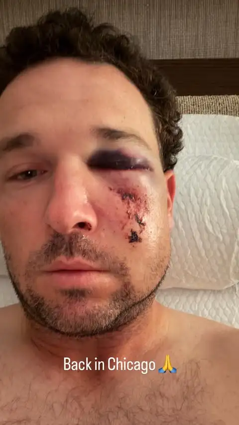 Alex Bregman受傷。圖片來源:Alex Bregman IG